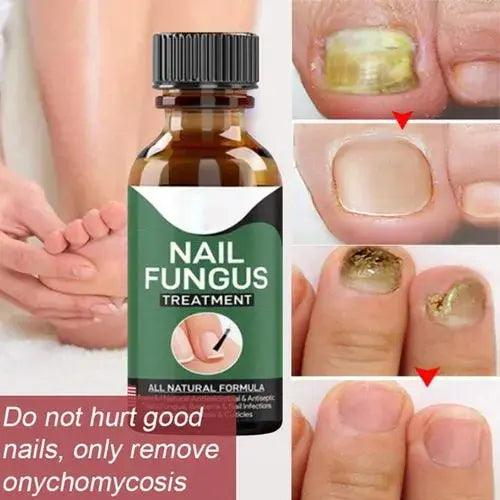 Nail Fungus Treatment -Advanced Antifungal Treatment